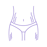 РАСТЯЖКИ, СТРИИ